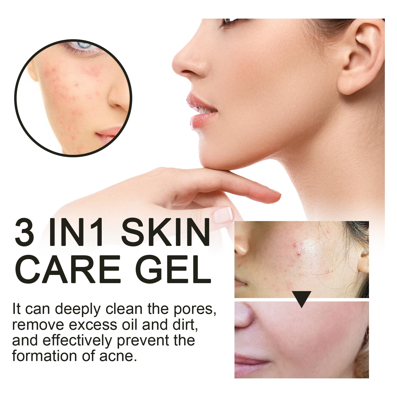 3 In1 Acne Repair Gel, Deep Cleanse, Fade Dark Spots, Clear Pores, Moisturize ,20g