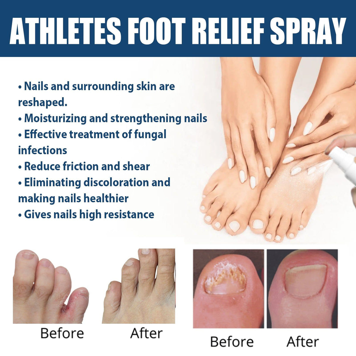 Athletes Foot Relief Spray, Fungal Infection Treatment, Odor & Itch Relief, Moisturizing Foot Care ,30ml