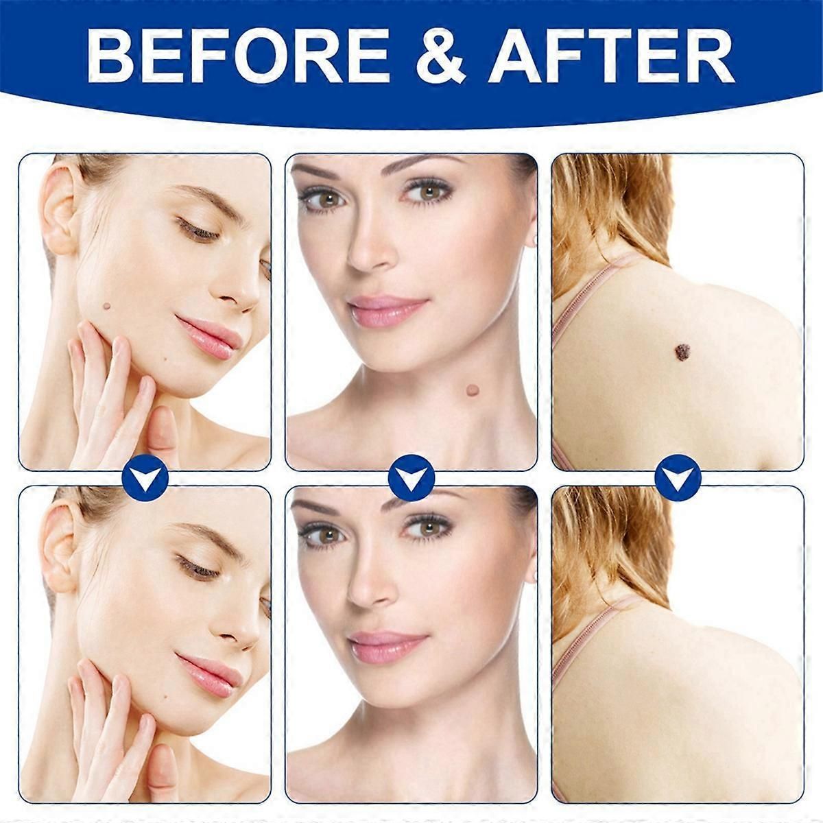 Painless Skin Tag Removal Kit With Easy Application Pen