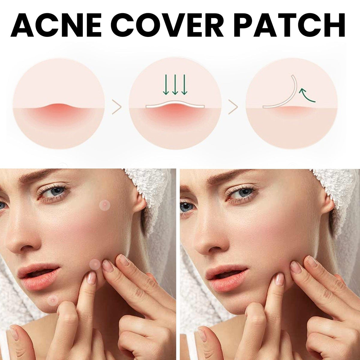 West & Month Acne Patch for Facial Care, Clear Skin, Pimple Spot Treatment ,72pcs