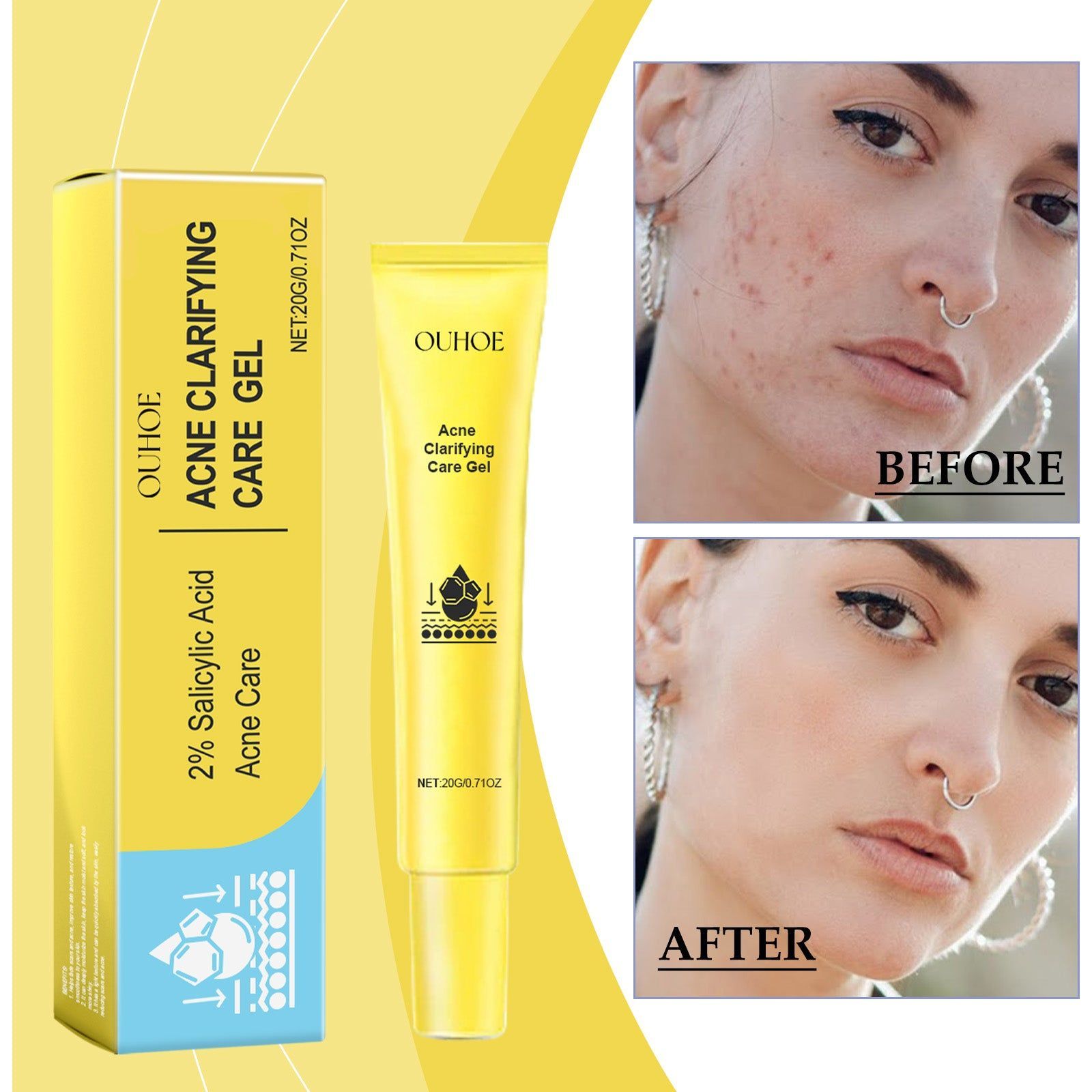 Clear Acne Fast with Acne Gel, Brightening, Skin Smoothing, Concealer ,20g