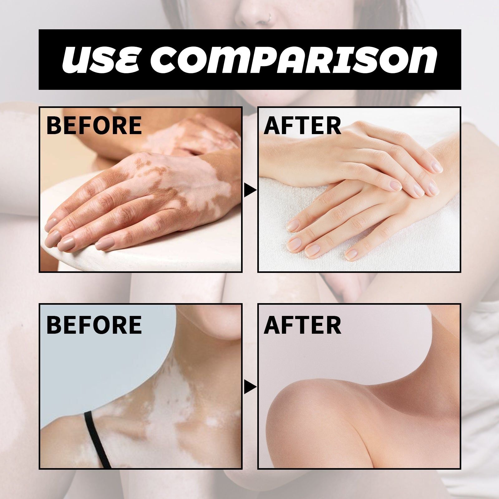 White Spots Removal Spray for Even Skin Tone, Moisturizing, Brightening, Fast Results ,30ml