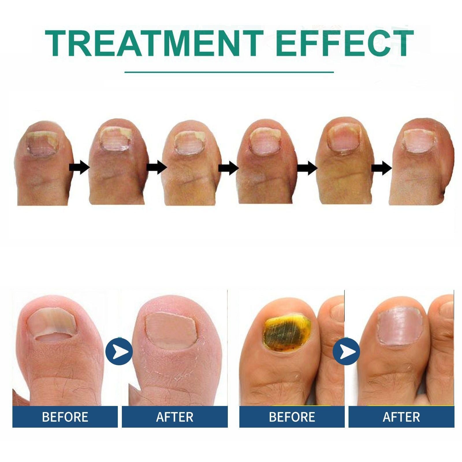 7 Day Nail Repair Serum for Stronger Faster Growing Nails, Fungal & Gray Nail Treatment ,7ml