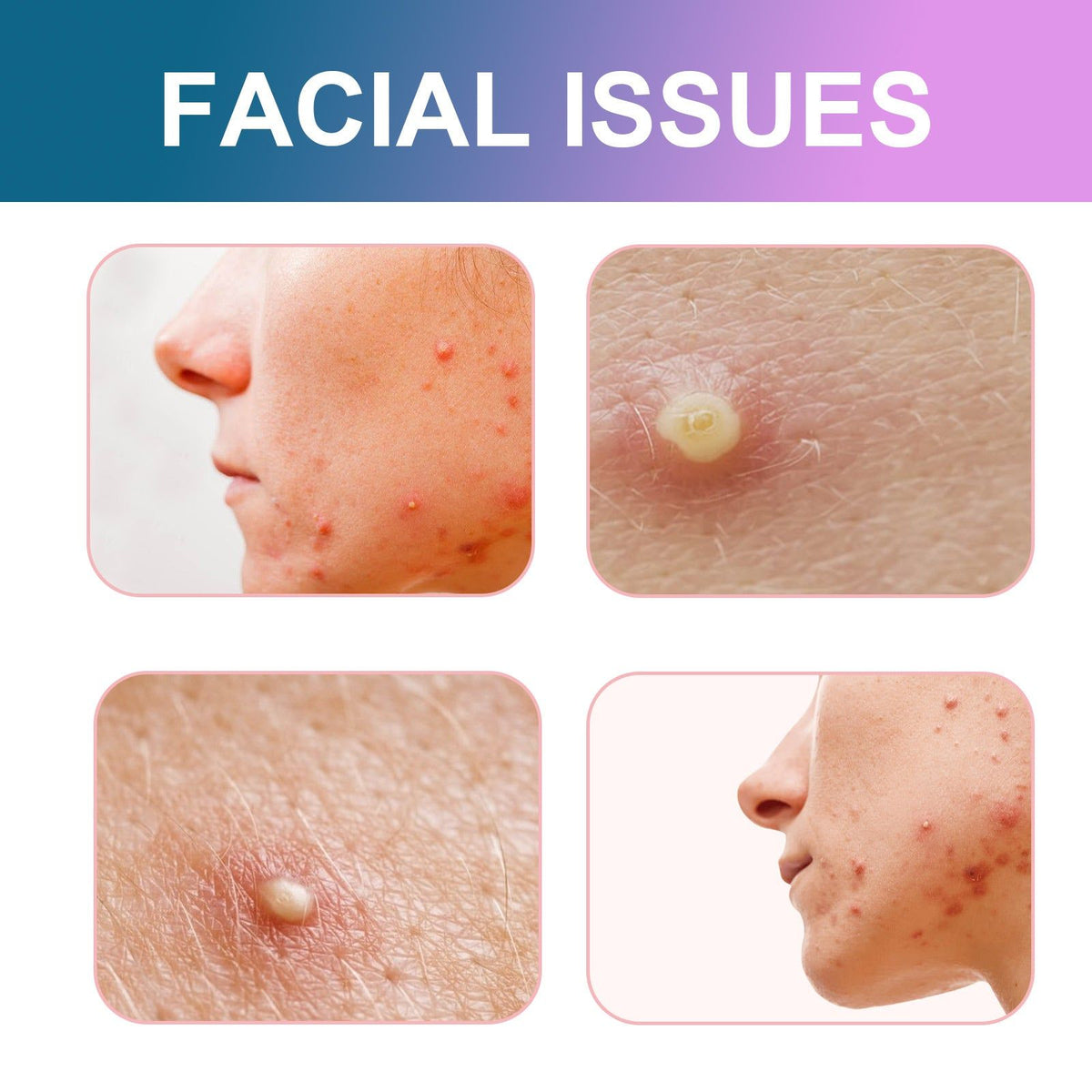 Reduce Acne Fast, Cute Color Pimple Patches, Clear Skin, Blemish Concealer ,96pcs