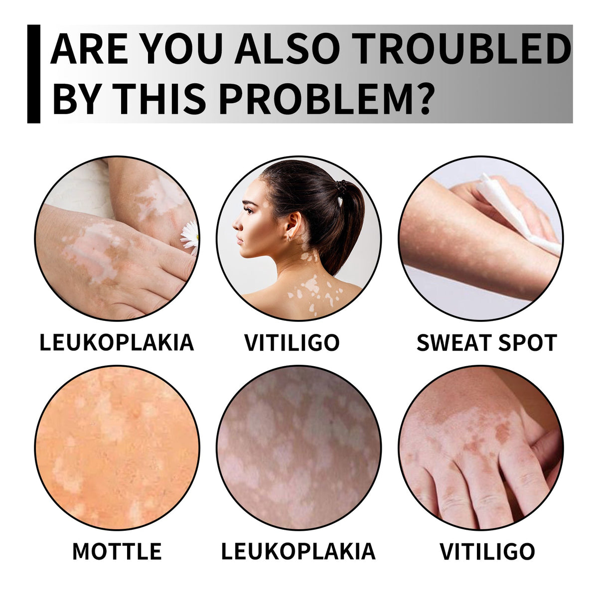 White Spots Removal Spray for Even Skin Tone, Moisturizing, Brightening, Fast Results ,30ml