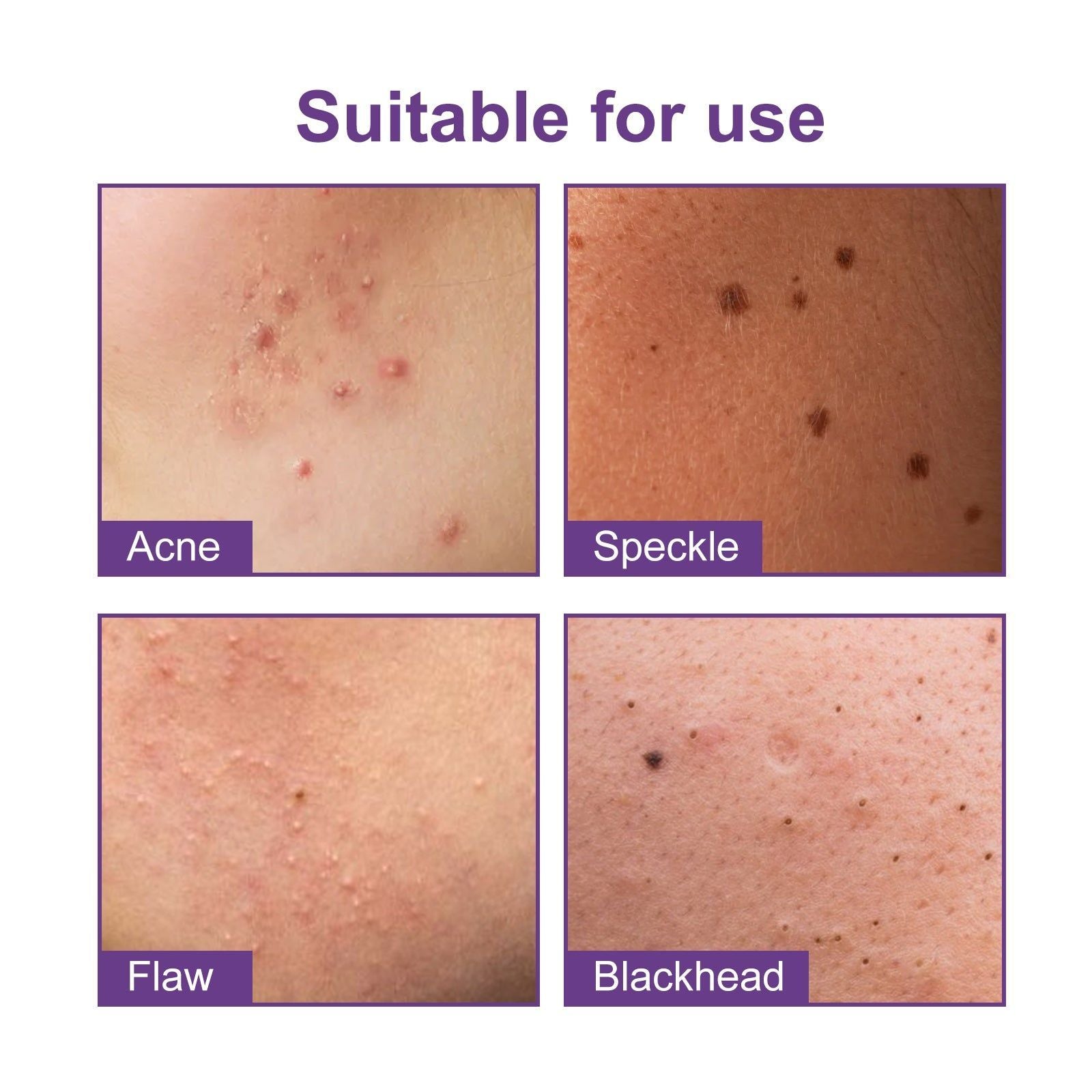 Reduce Acne Fast with Acne Patches, Clear Pores, Heal Skin, Natural Ingredients ,180pcs