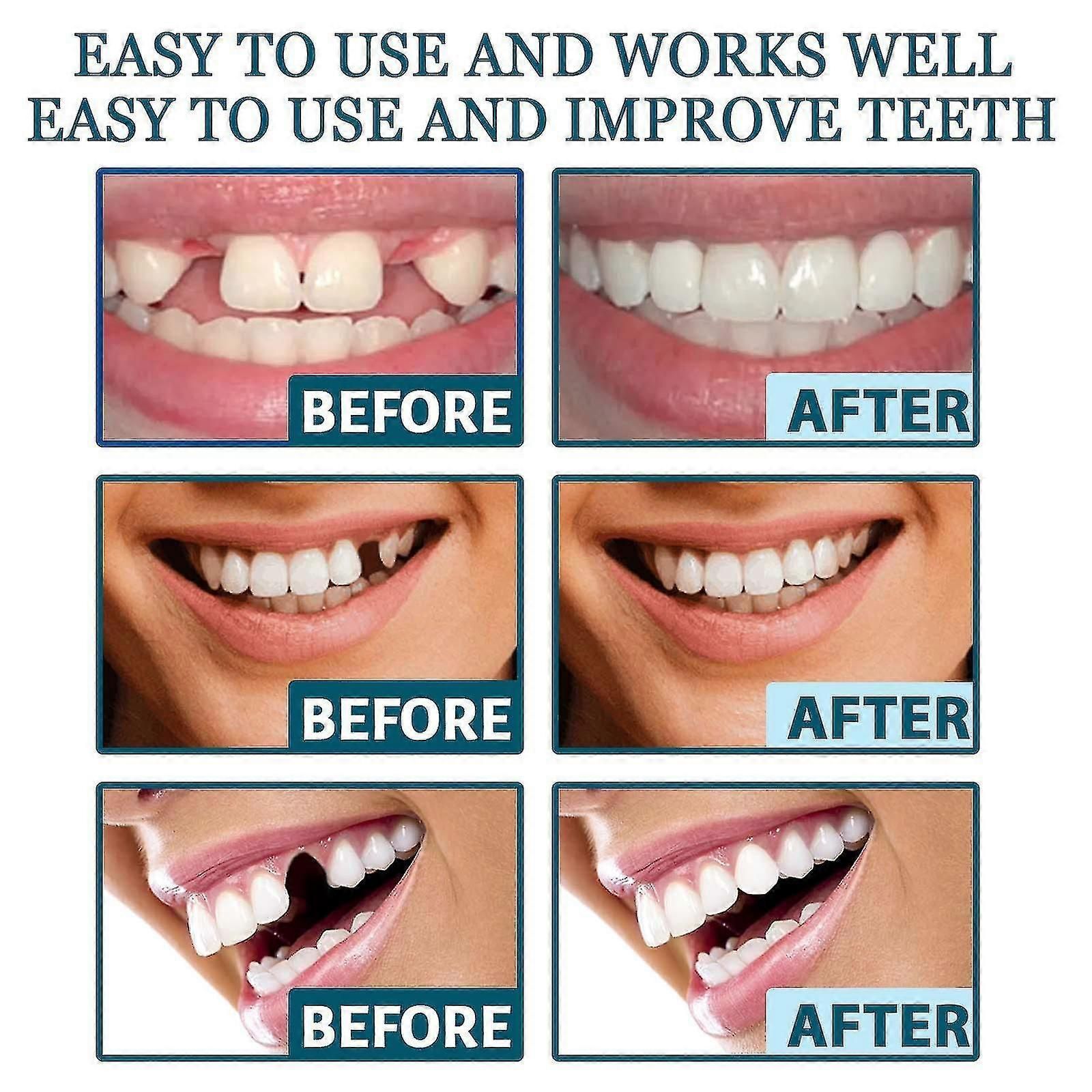 Adjustable Snap-on Dentures, Veneers Denture Braces Plus Denture Cases, Temporary Fillings Braces Interdental Fillings Straightening Dentures Kit zxin