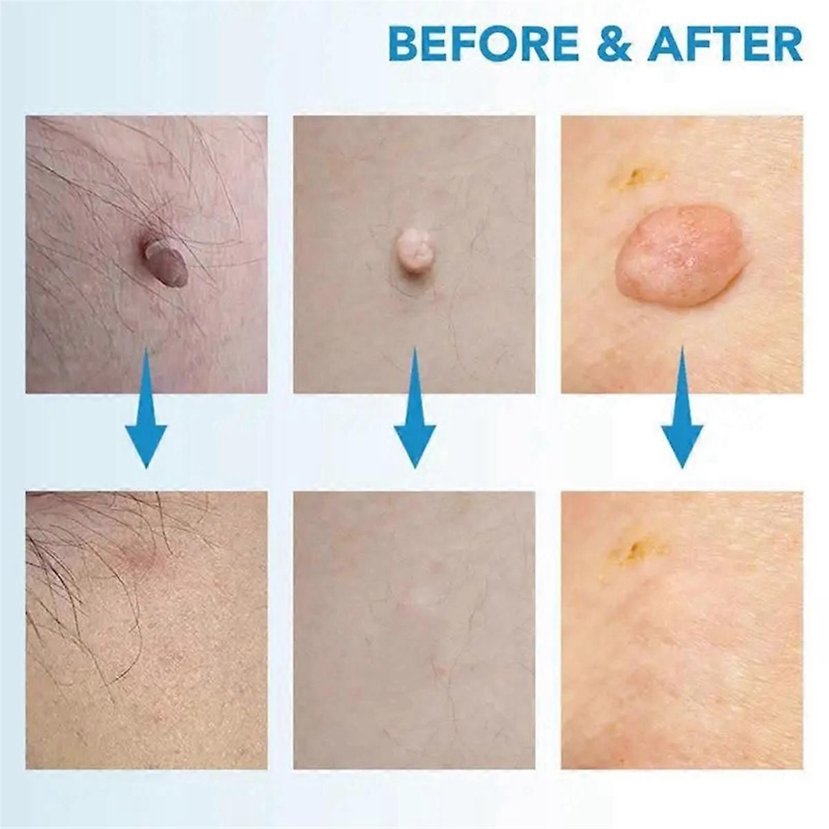 Painless Skin Tag Removal Kit With Easy Application Pen