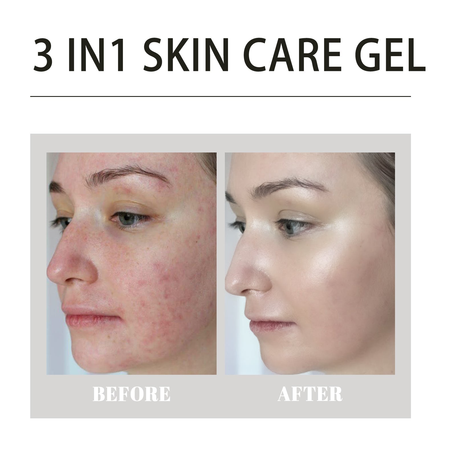 3 In1 Acne Repair Gel, Deep Cleanse, Fade Dark Spots, Clear Pores, Moisturize ,20g