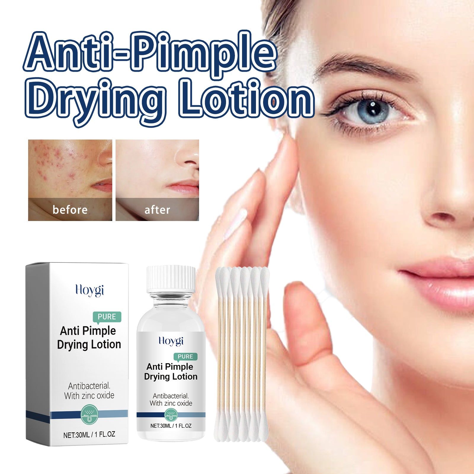 Anti-Pimple Drying Lotion, Facial Cleansing and Repair, Acne Marks, Sensitive Skin Care ,1set