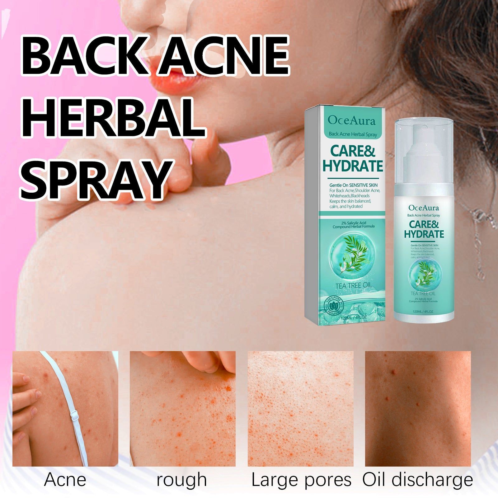 Oce Aura Back Acne Herbal Spray, Repair Acne Marks, Clear Skin, Natural Acne Solution ,120ml