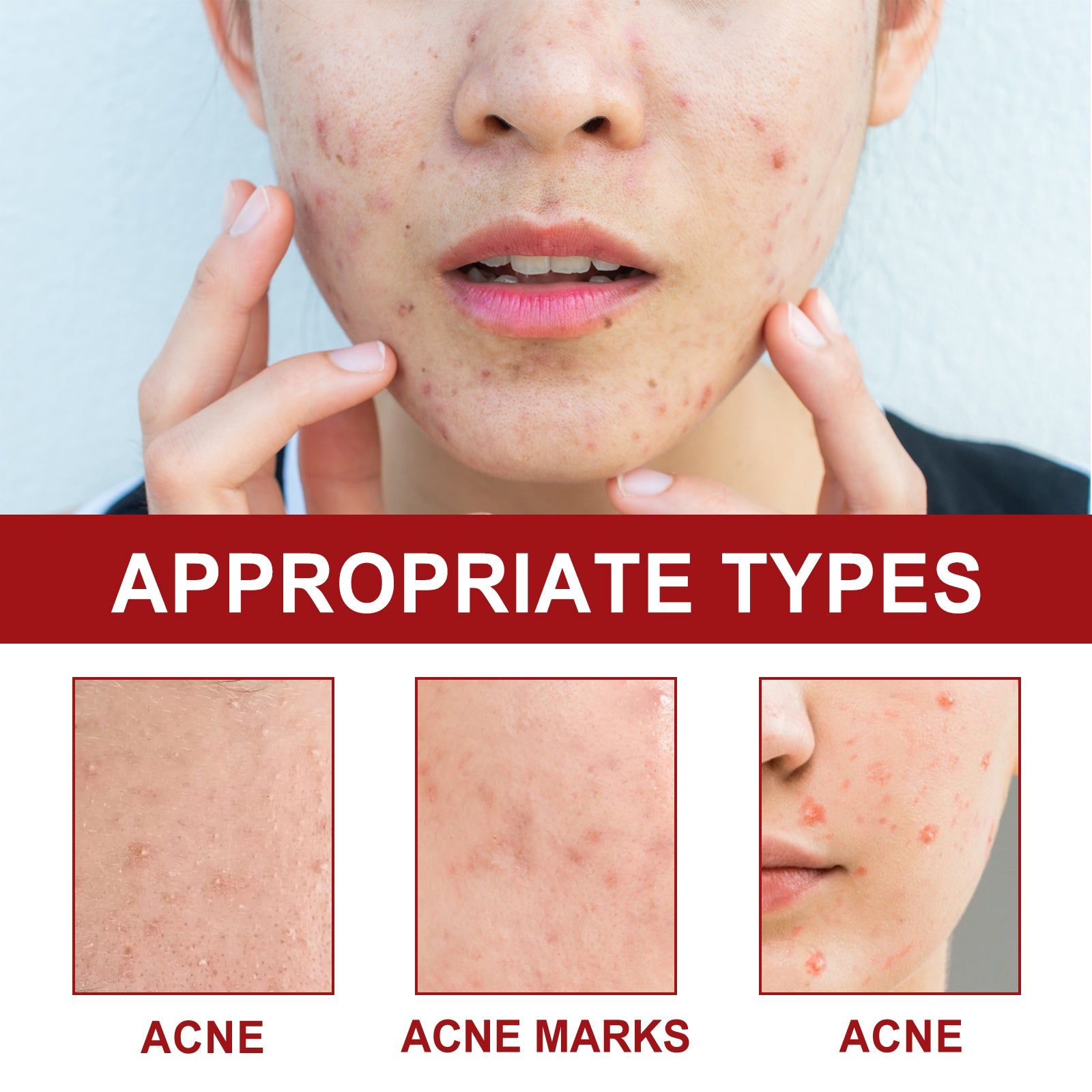 Facial Care Acne Patches, Clear Skin, Pimple Spot Treatment, Pore Cleanser ,180 patches