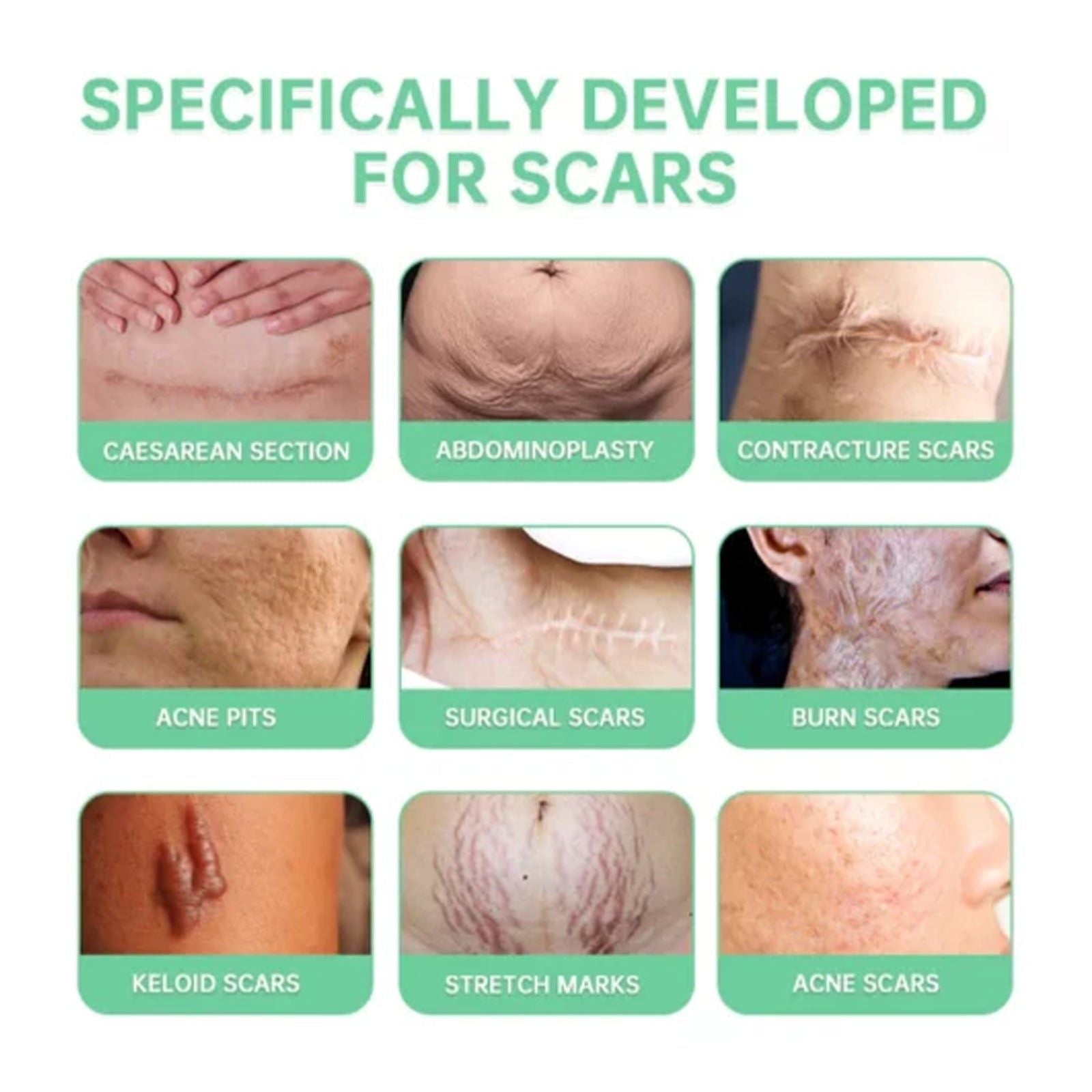 Scar Fade Spray, Pregnancy & Surgery Scar Repair, Moisturizing Skin Care ,20g