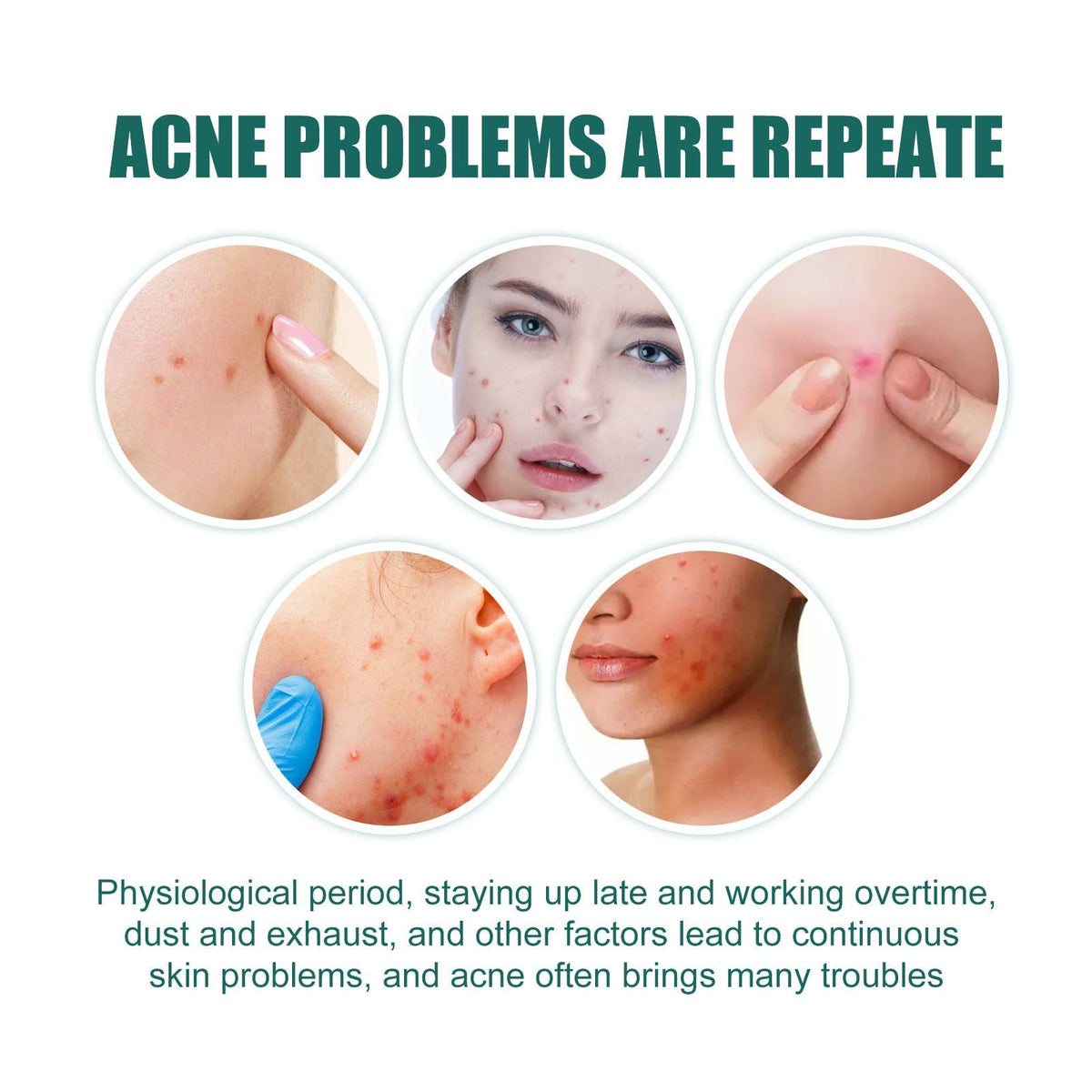 Cartoon Acne Pimple Patches Hydrocolloid Spot Stickers 112pcs