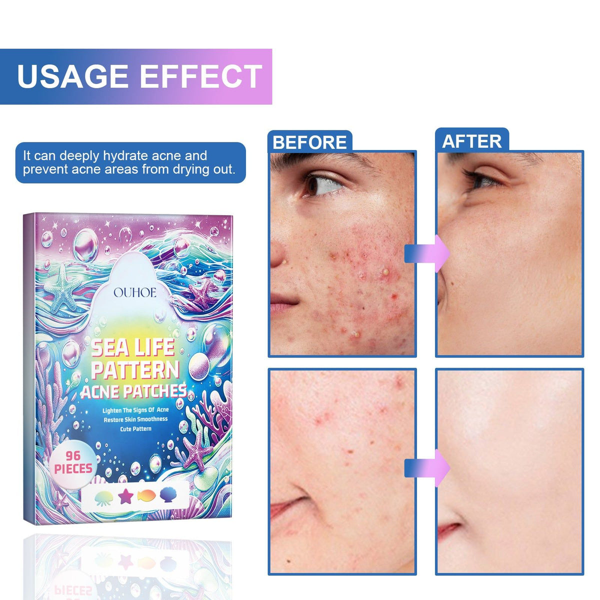 Reduce Acne Fast, Cute Color Pimple Patches, Clear Skin, Blemish Concealer ,96pcs