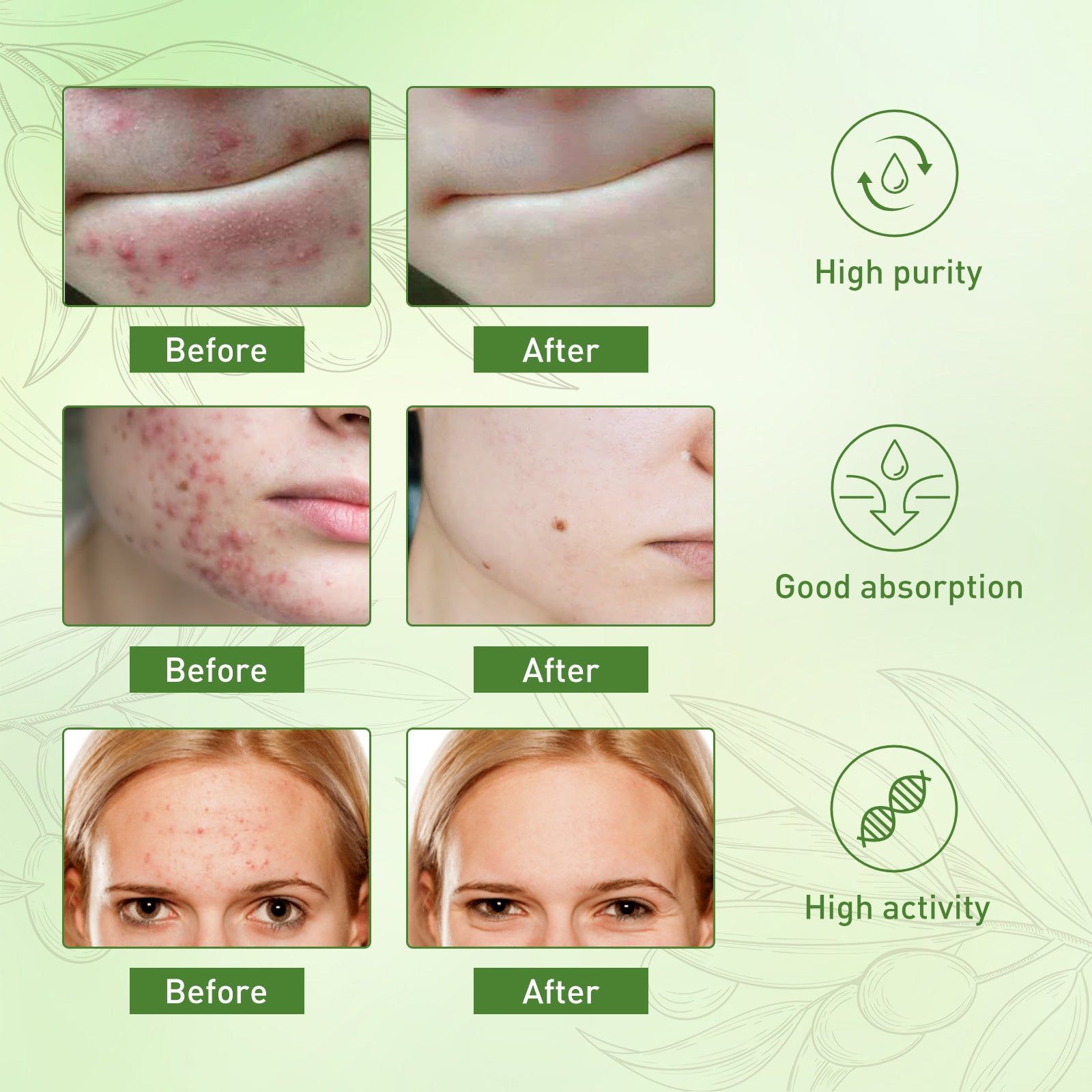 Acne Essential Oil, Remove Mites, Moisturize, Fade Red, Clear Skin ,30ml