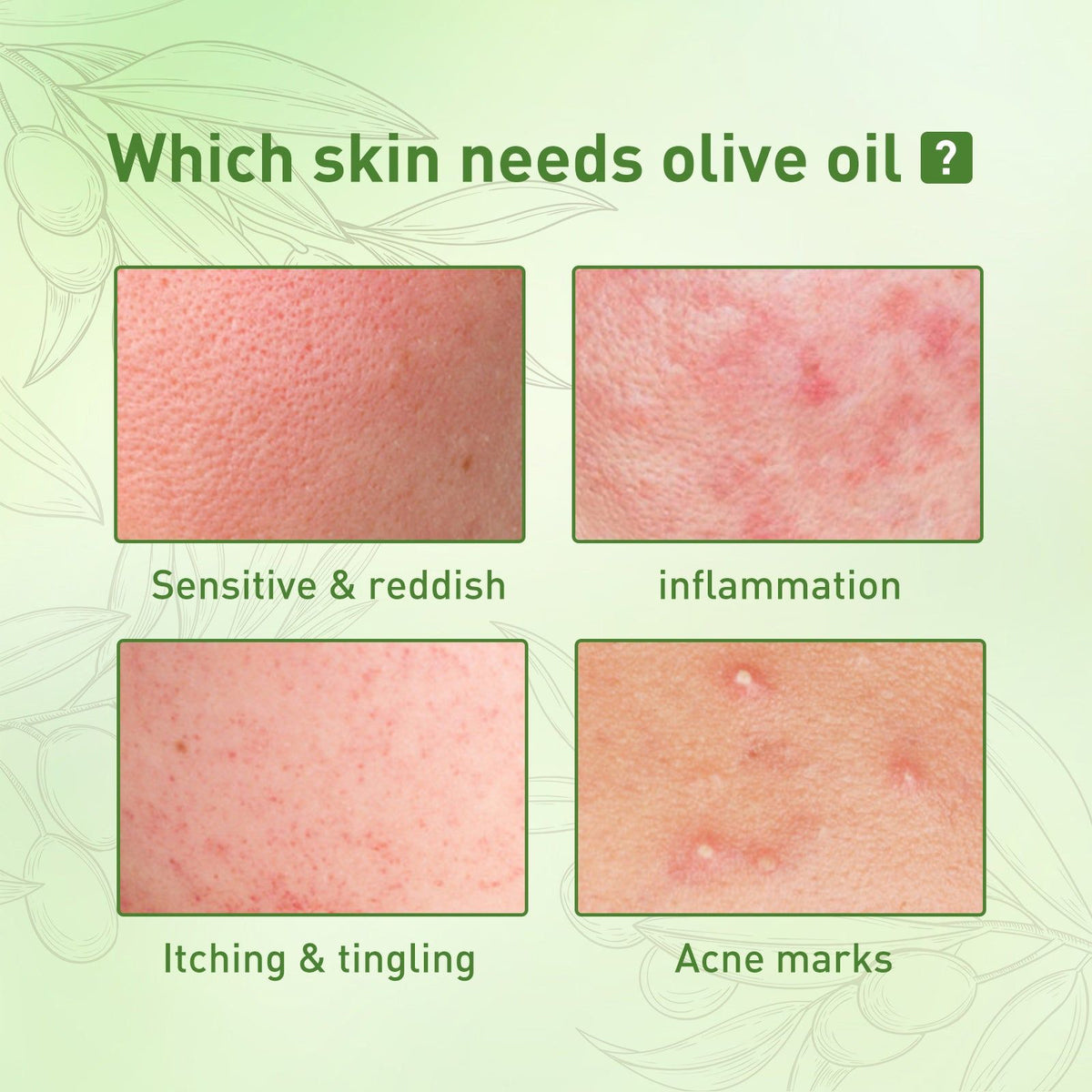 Acne Essential Oil, Remove Mites, Moisturize, Fade Red, Clear Skin ,30ml